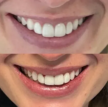 Close-up comparison of two smiling mouths, showing white teeth before and after whitening