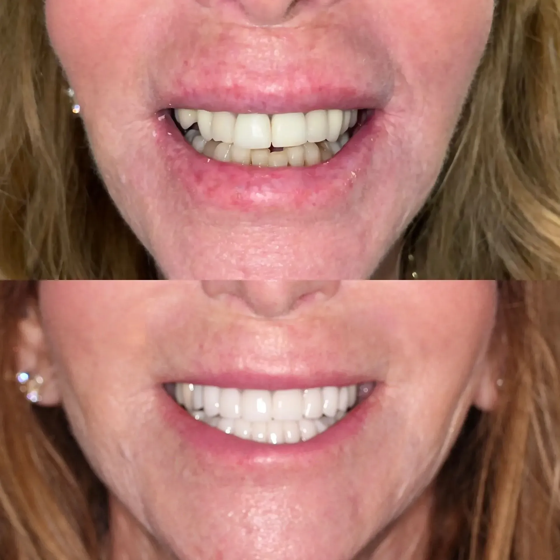 Two close-up smiles showing teeth before and after whitening treatment