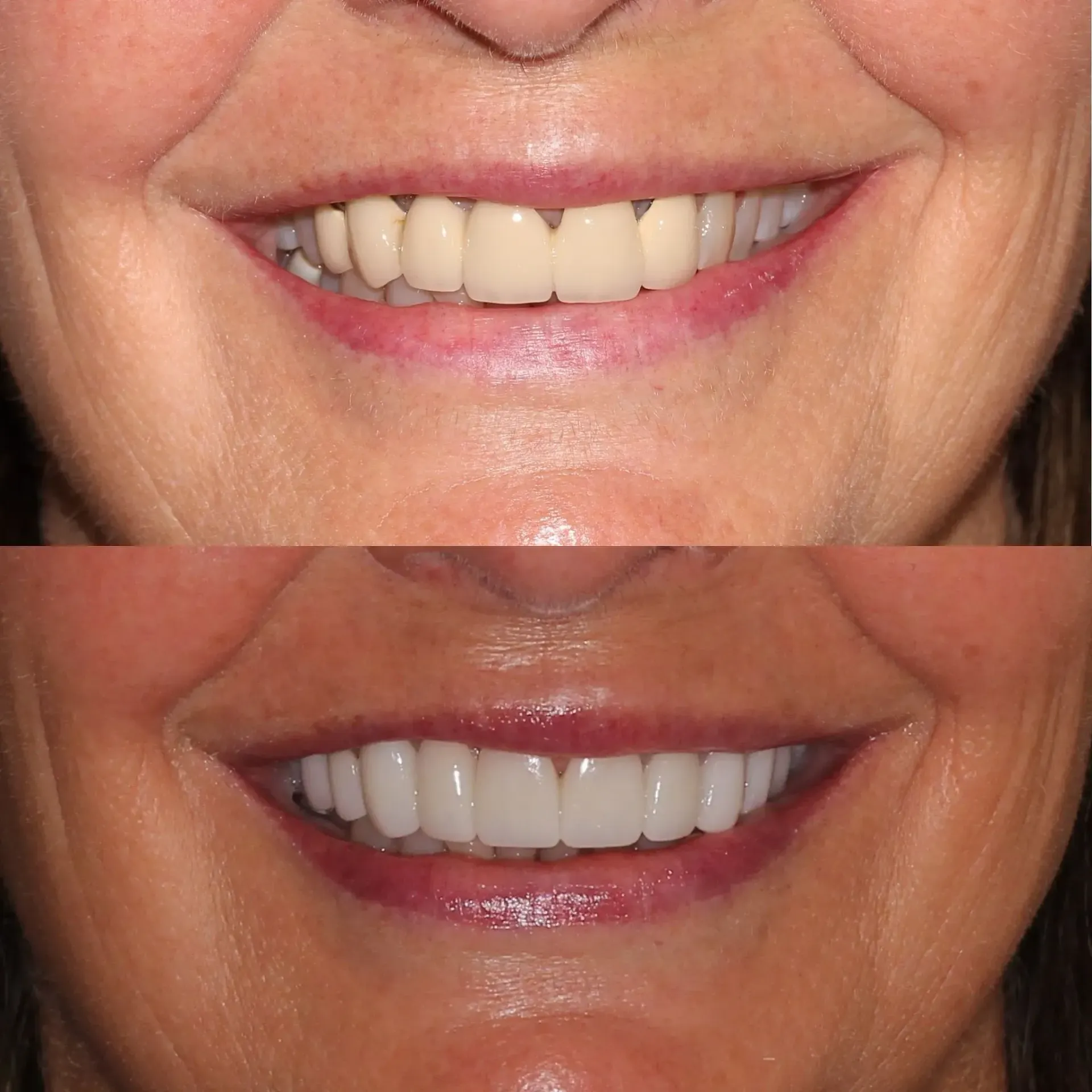 Close-up of a smiling mouth, shown before-and-after with whiter teeth on the bottom