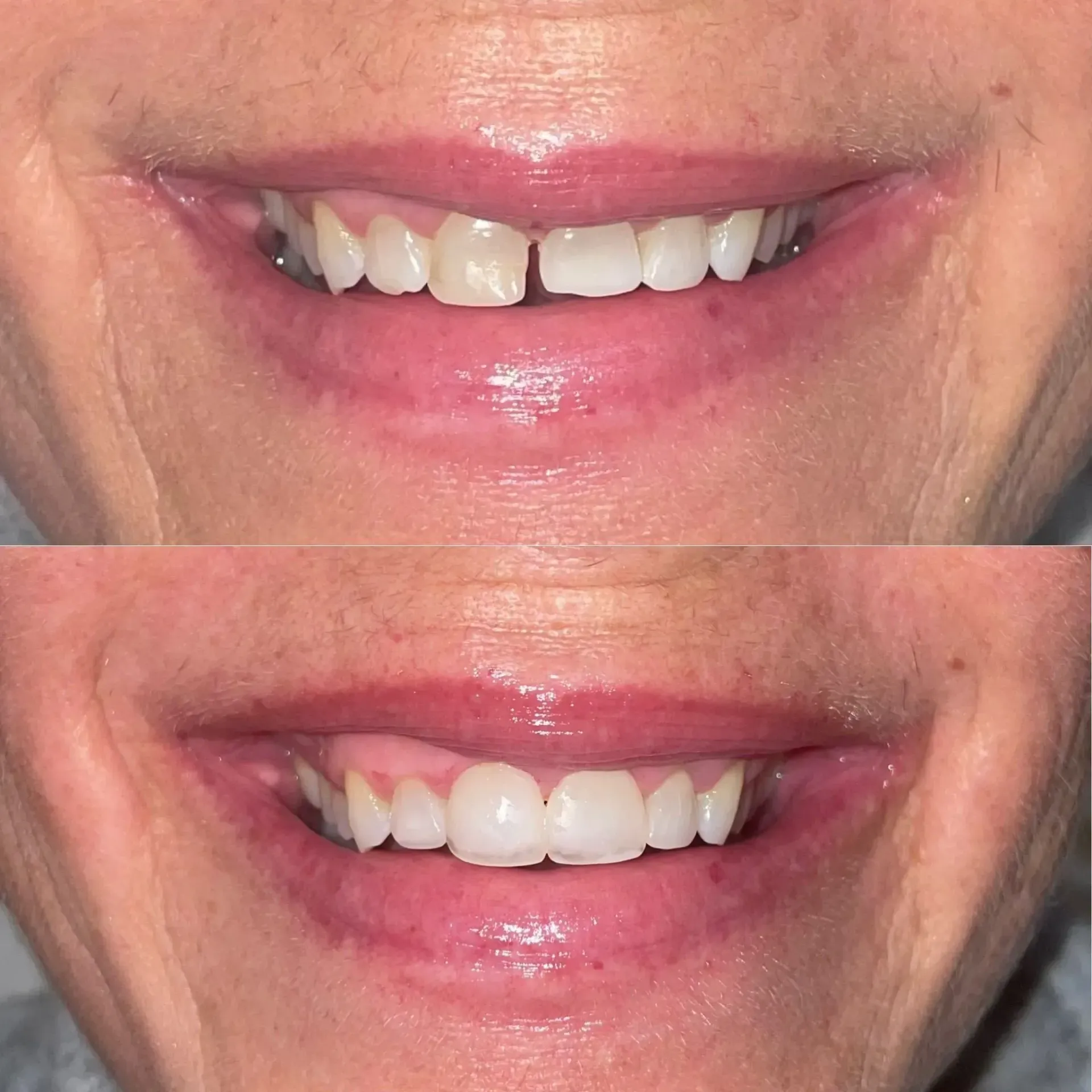 Close-up of a smiling mouth showing before-and-after teeth alignment.