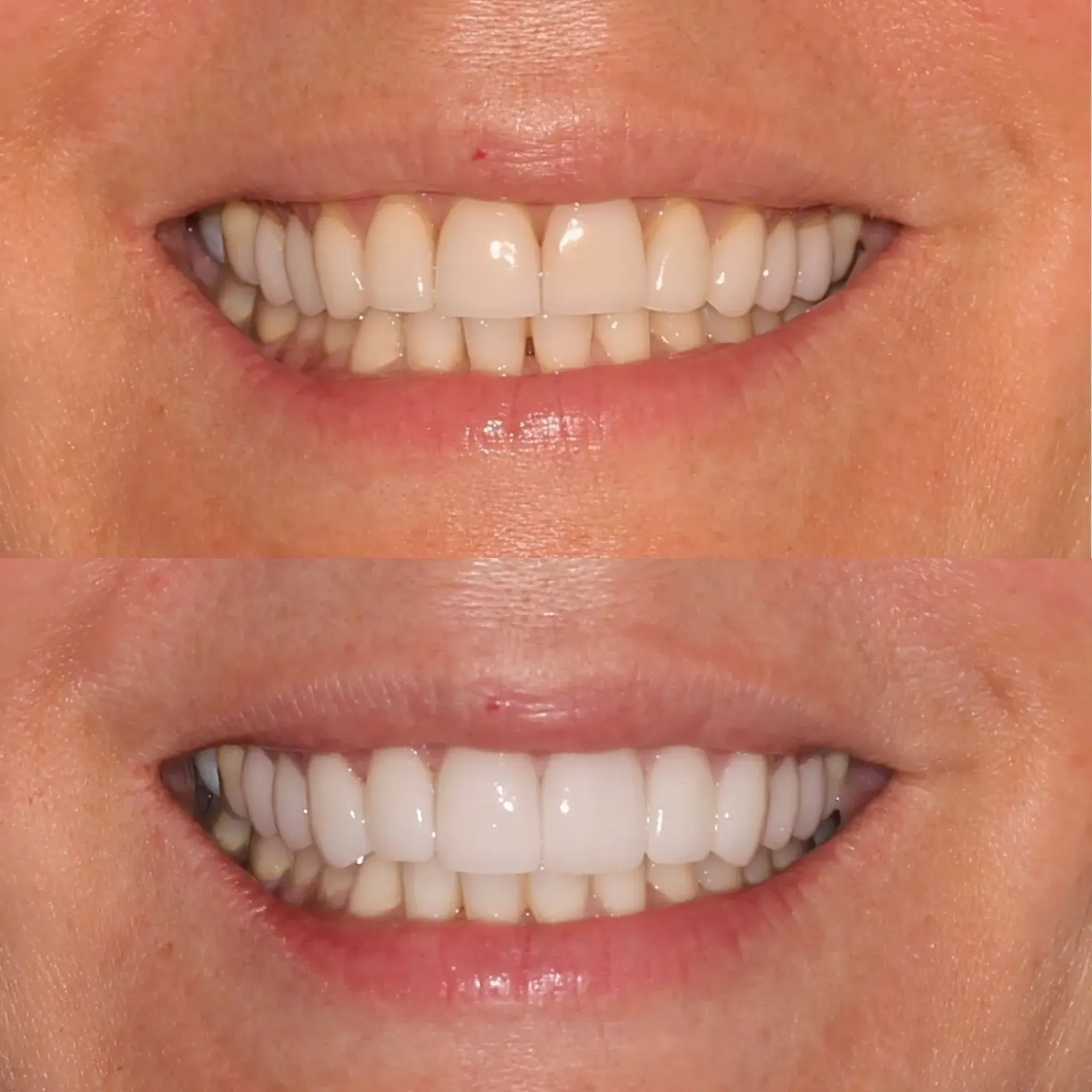 Side-by-side close-up of a smiling mouth before and after teeth whitening