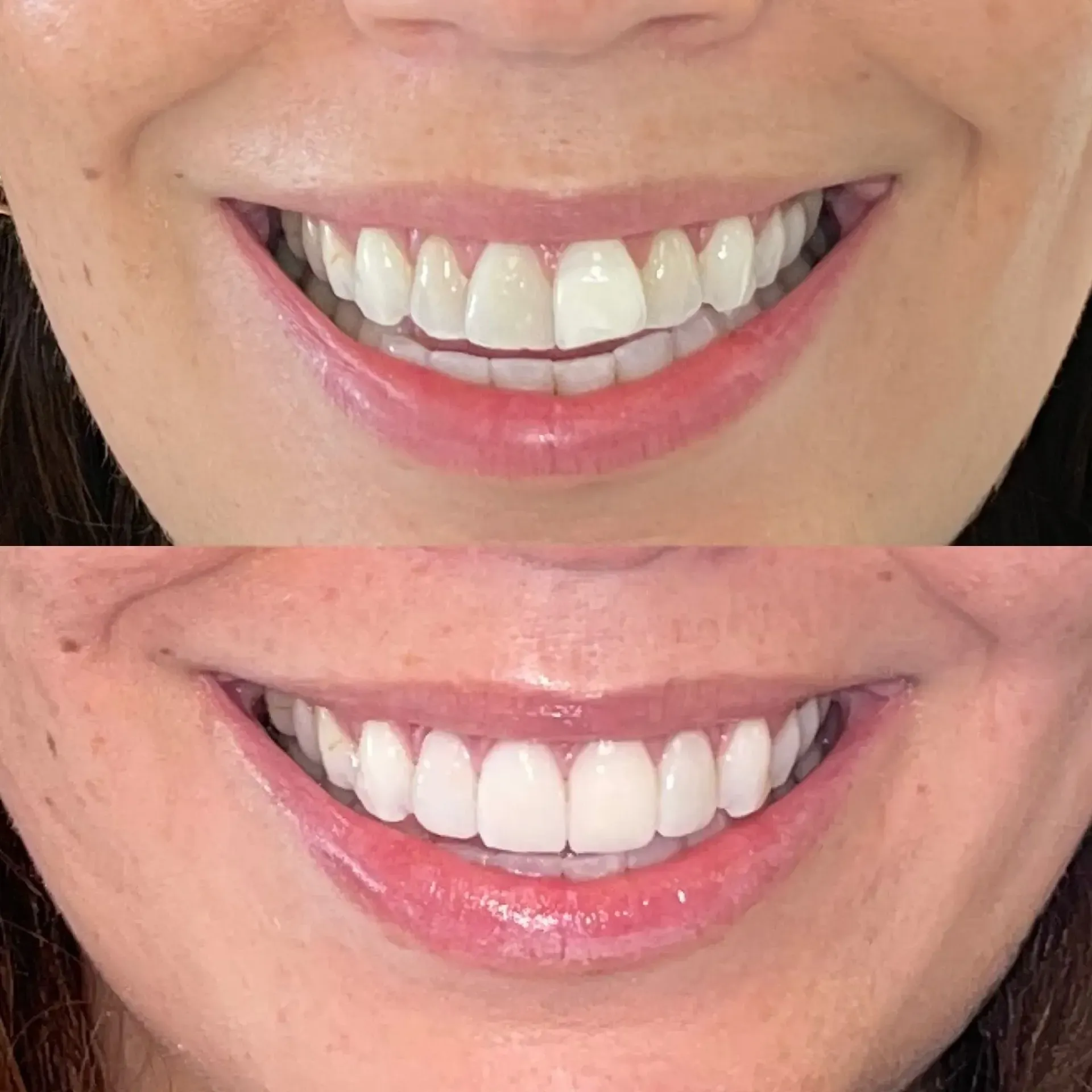 Close-up of a smiling mouth showing teeth before and after whitening