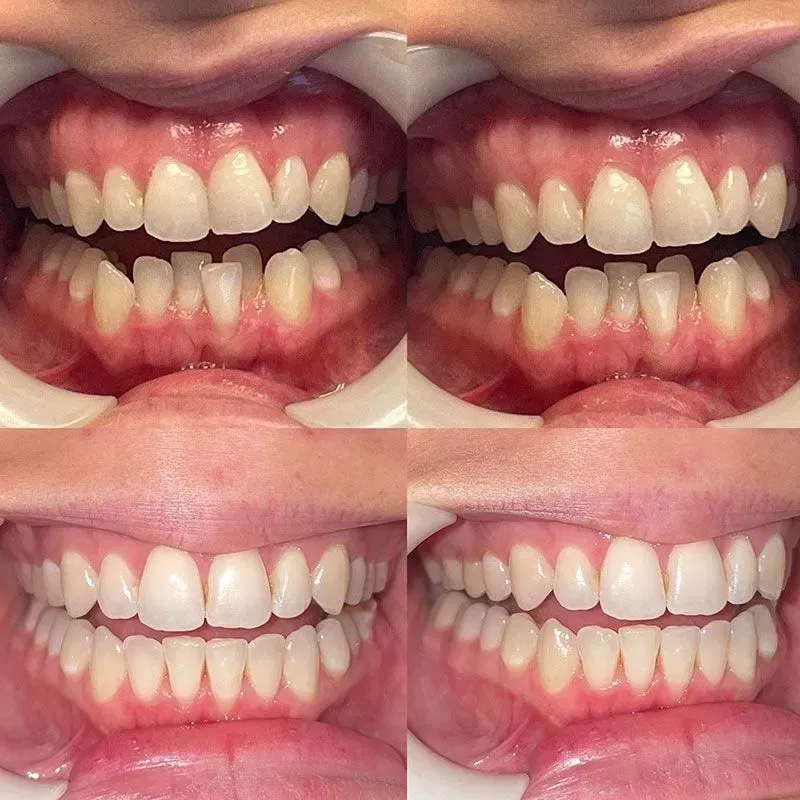 Four close-up mouth photos comparing teeth and gums under different lighting conditions
