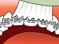 Teeth with braces being brushed; white toothbrush removing plaque.