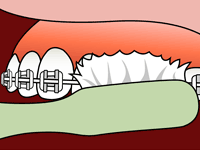 Illustration of brushing teeth with braces. A green toothbrush cleans teeth with visible brackets.