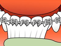 Brushing teeth with braces: toothbrush cleaning teeth with metal brackets, showing oral hygiene.