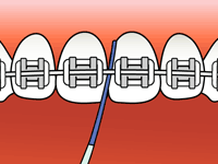 Teeth with braces, being cleaned with a small interdental brush.