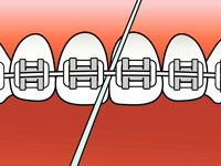 Teeth with braces, dental floss being used to clean between teeth.