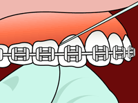 Flossing with braces: a hand is guiding floss between teeth and under the wire of braces.