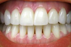 A close up of a person 's teeth with white teeth.