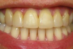 A close up of a person 's teeth with a red lip.
