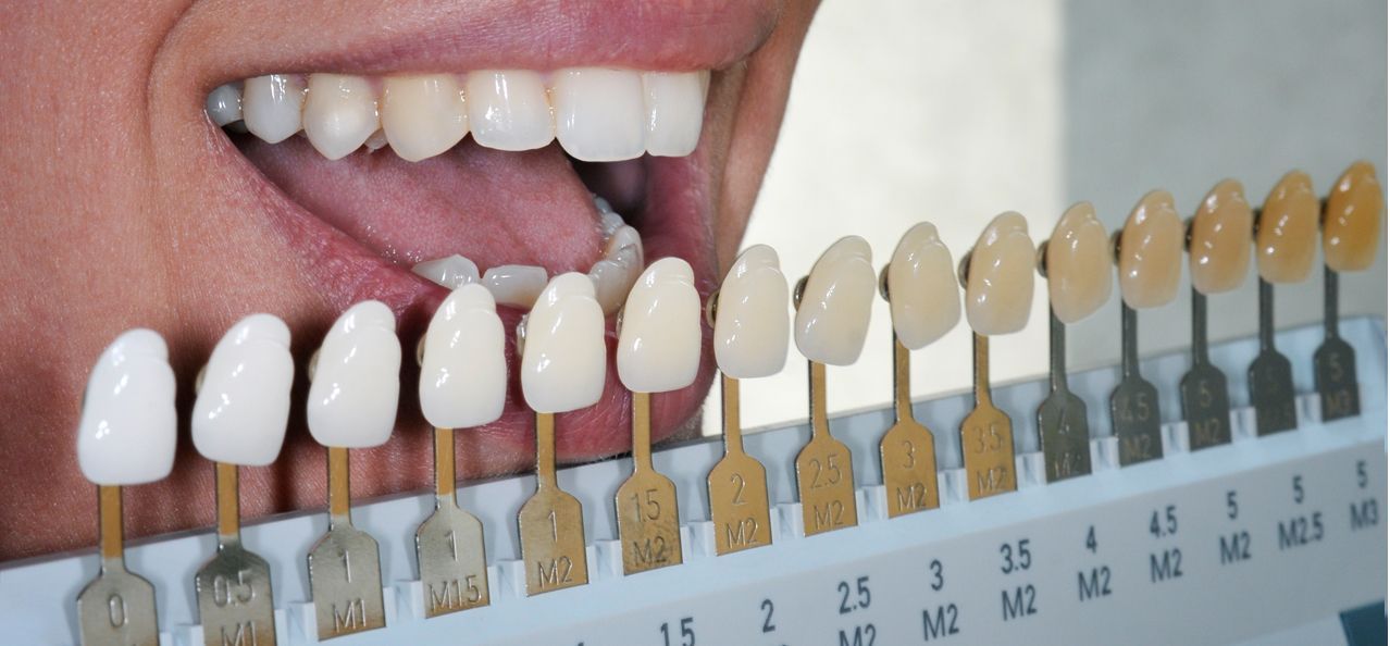 A close up of a person 's teeth next to a tooth color chart.