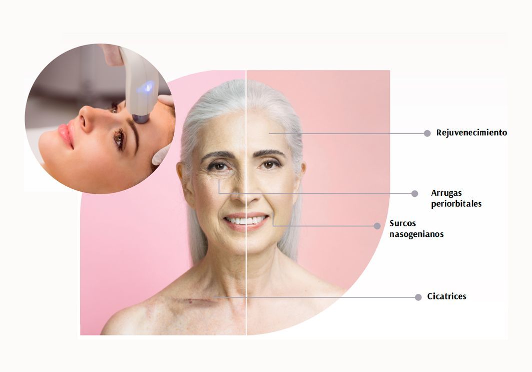 Rostro de mujer con arrugas resaltadas y una fotografía ampliada de un tratamiento facial que se está realizando.
