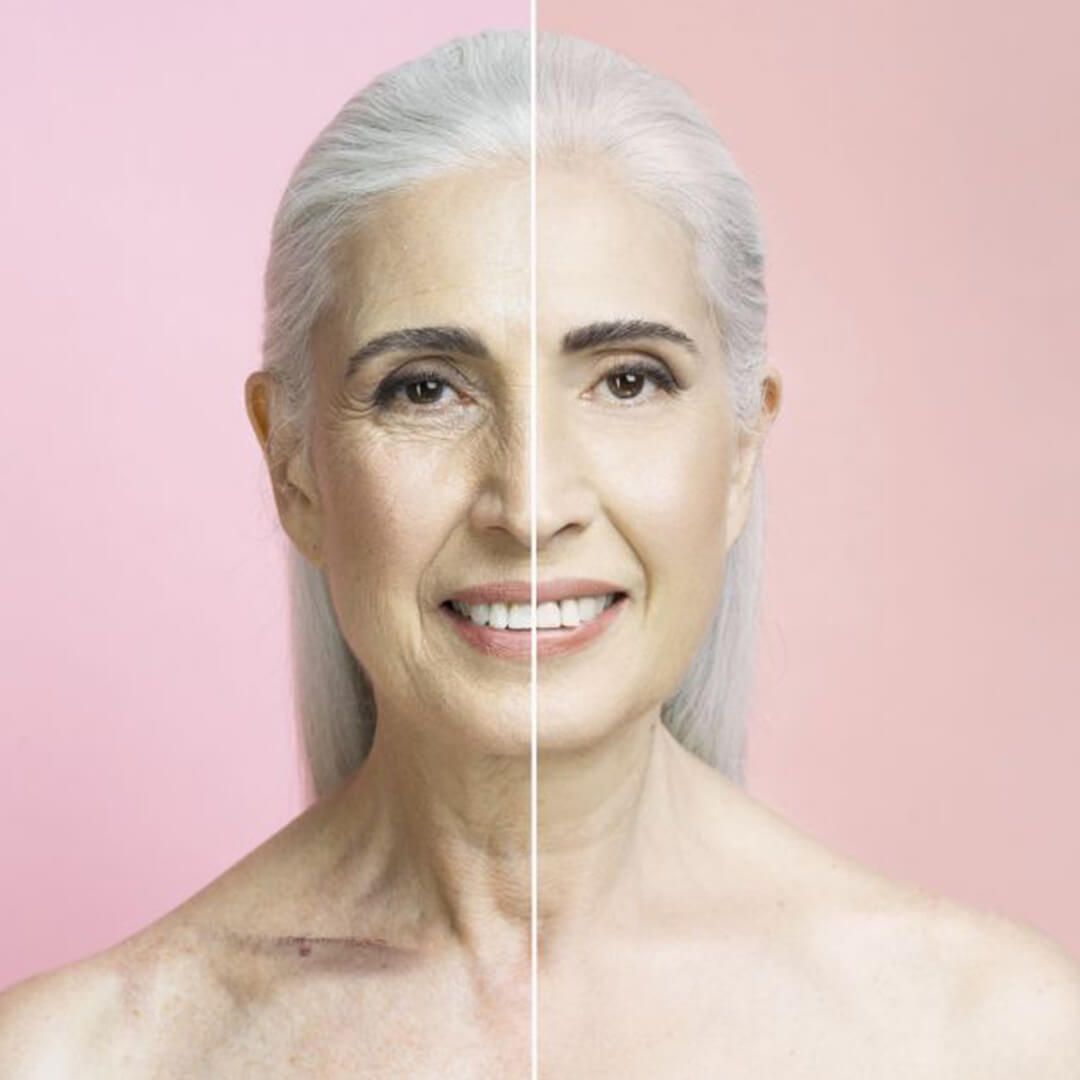 Rostro de mujer con arrugas resaltadas y una fotografía ampliada de un tratamiento facial que se está realizando.