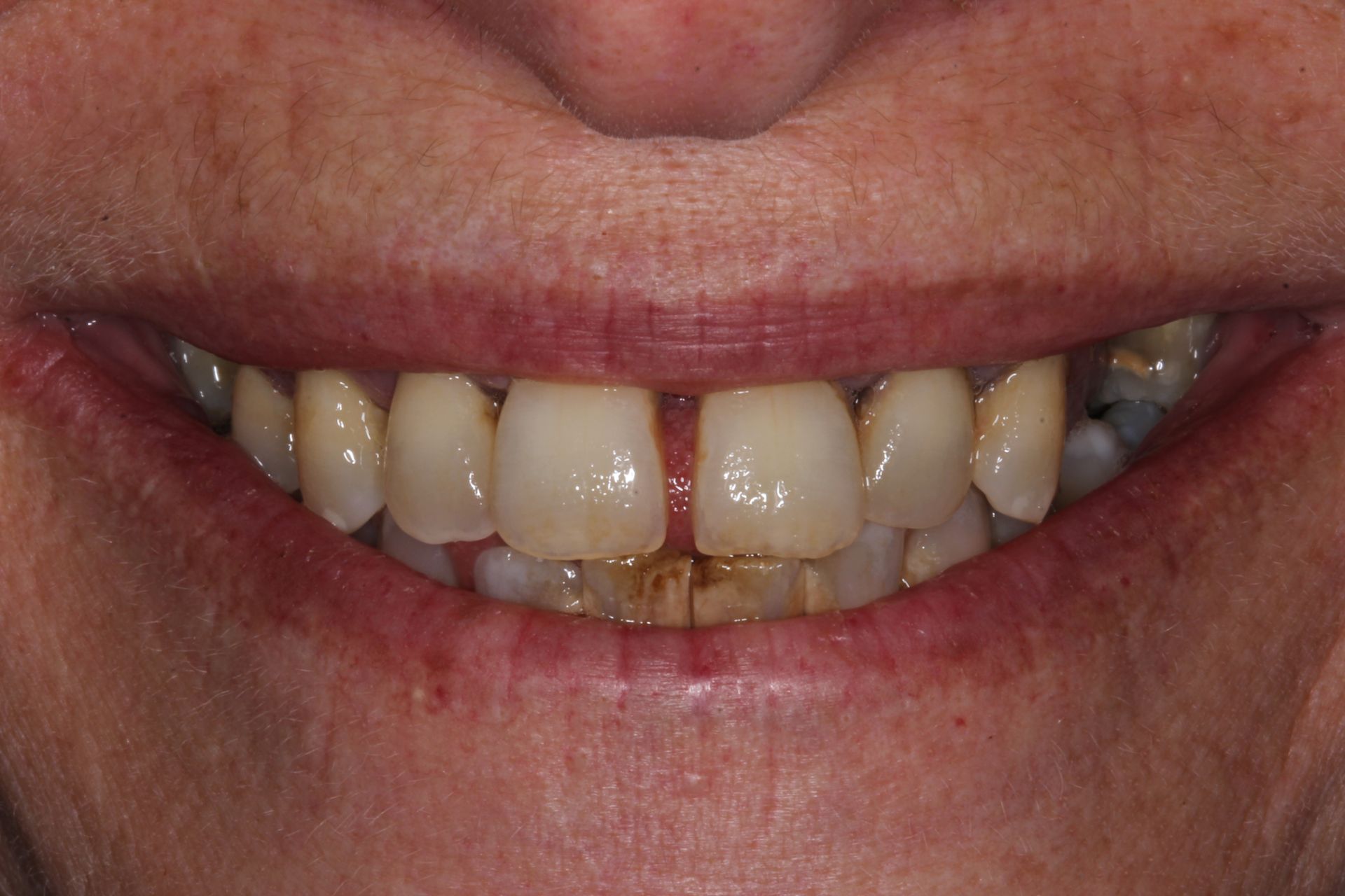 Fixing a decayed smile before
