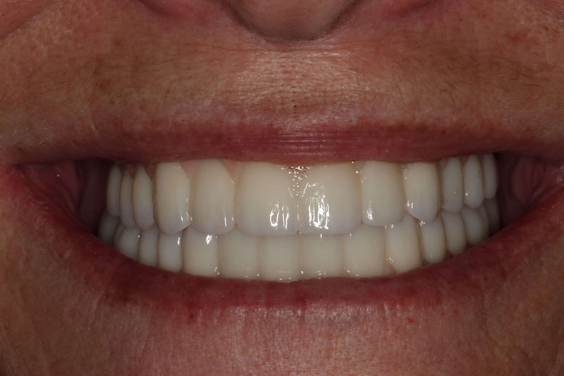 Fixing a decayed smile after