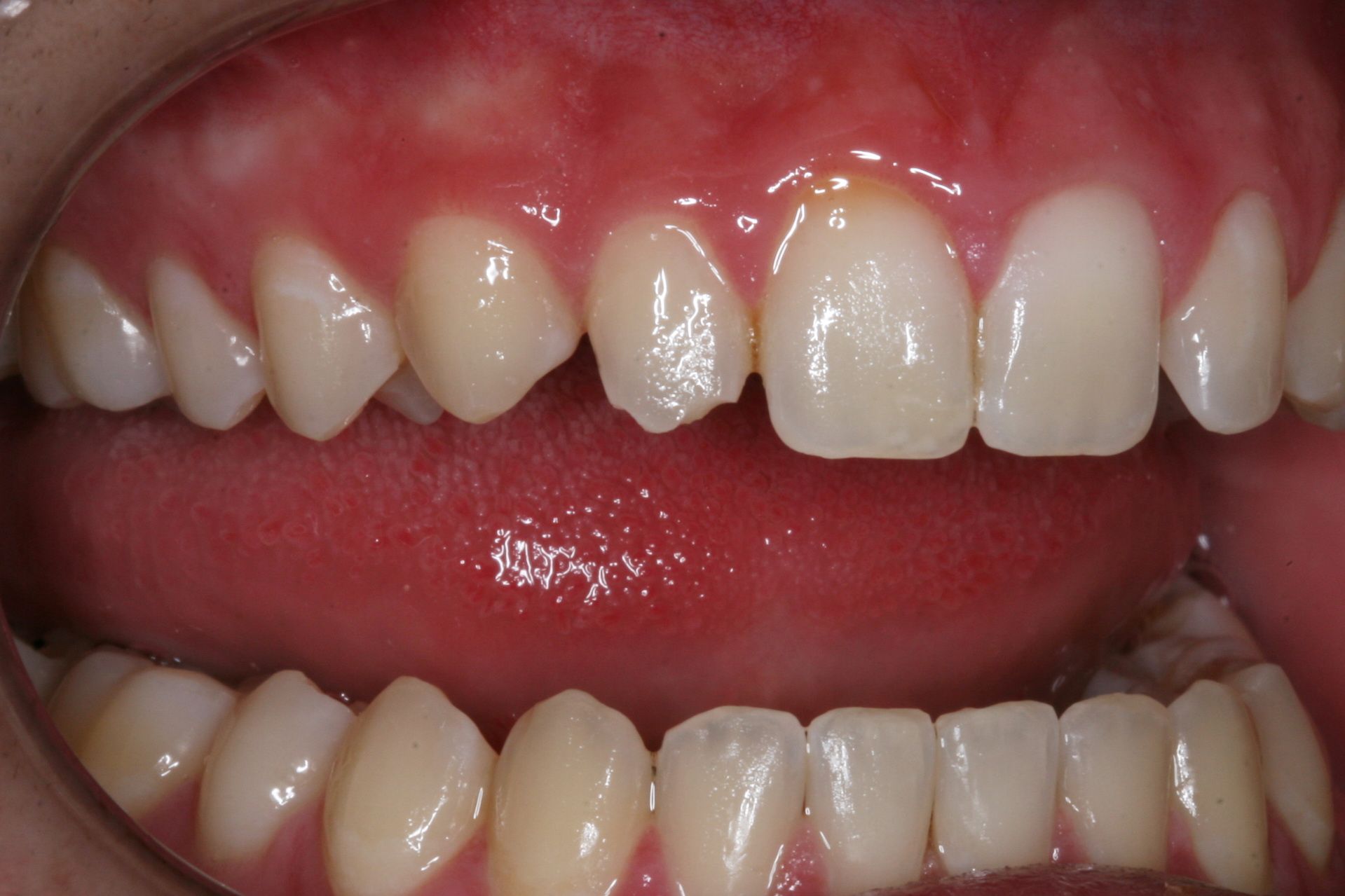 Veneers for an even smile before