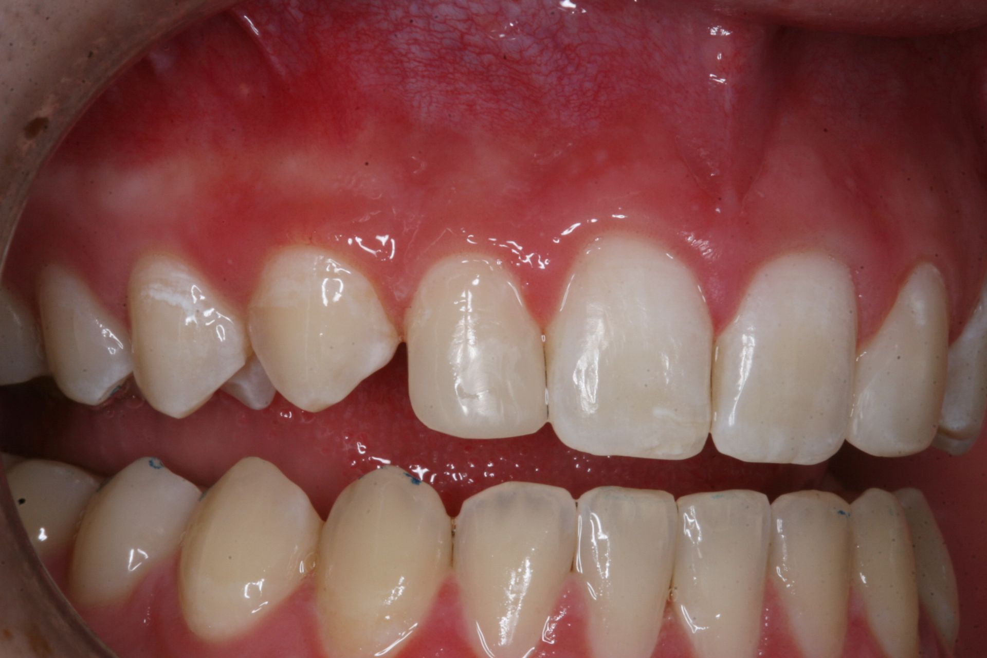 Veneers for an even smile after