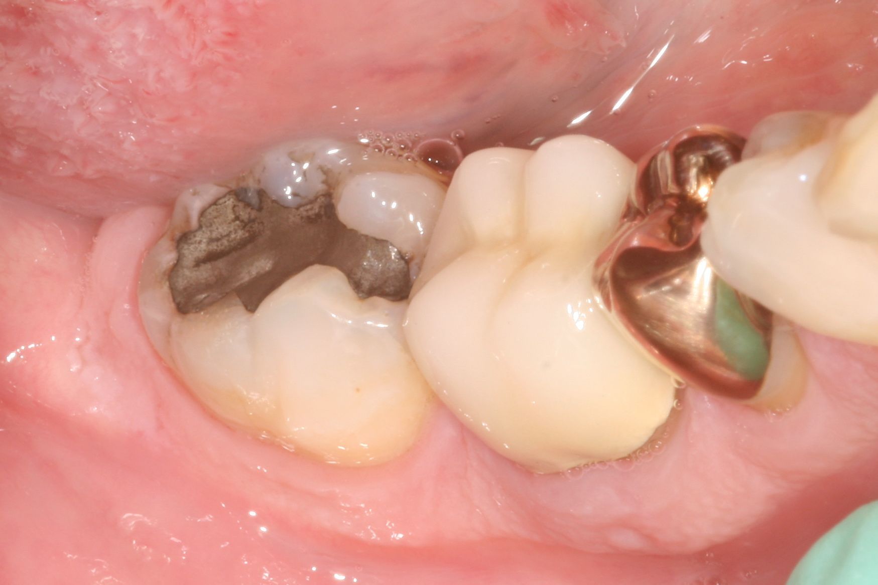Full mouth makeover before