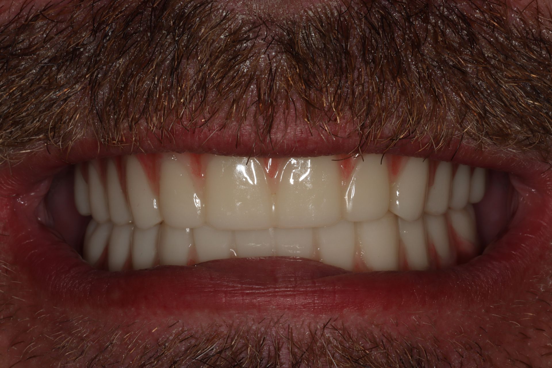 Fixing a decayed smile after