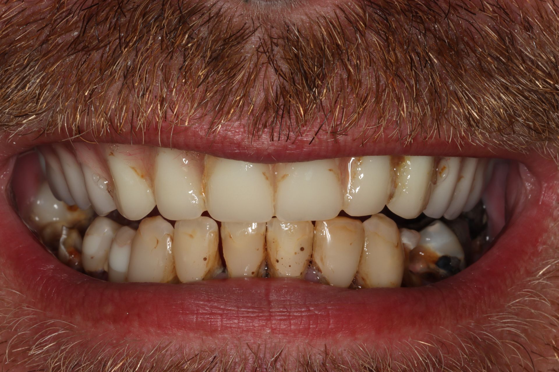 Fixing a decayed smile before