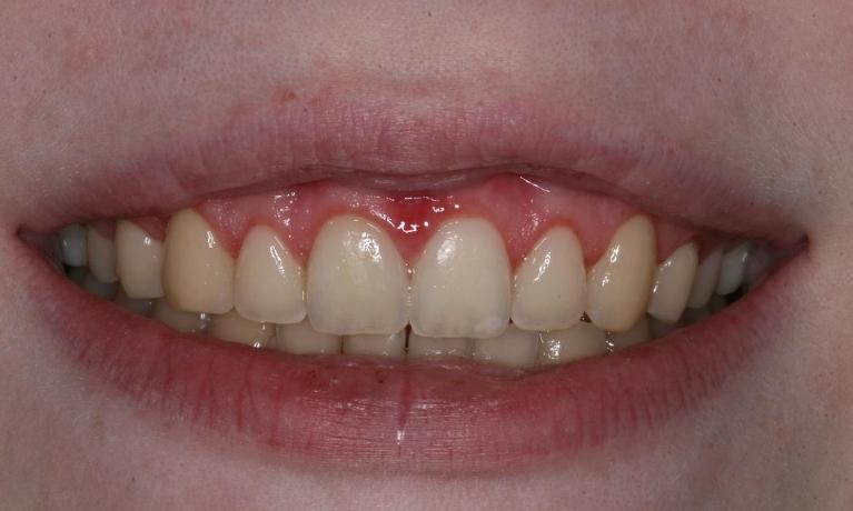 Gummy smile after