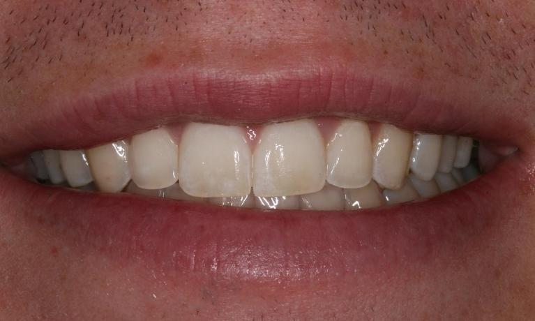 Crowded teeth after