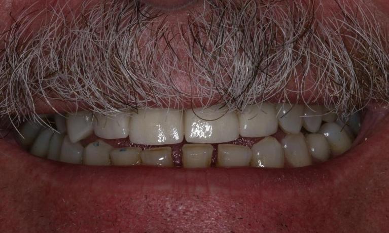 Crowns for a nervous patient after