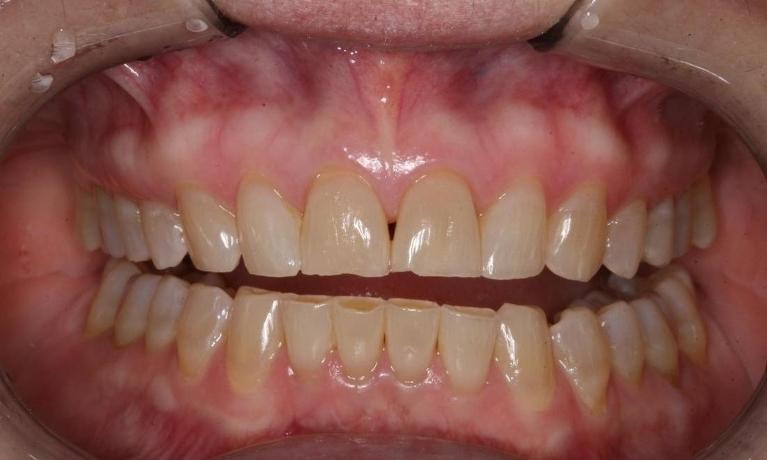 Worn down teeth from grinding before