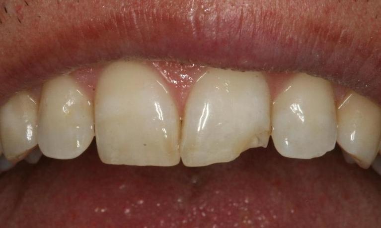 Repairing a chipped tooth before