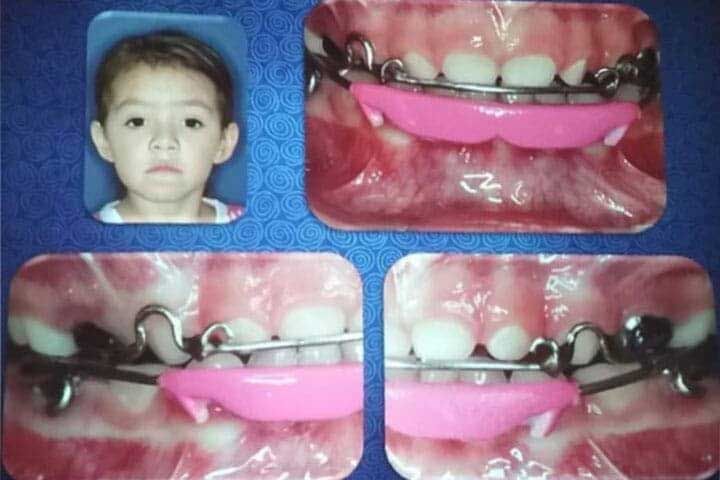 ODONTOKID - CARIES