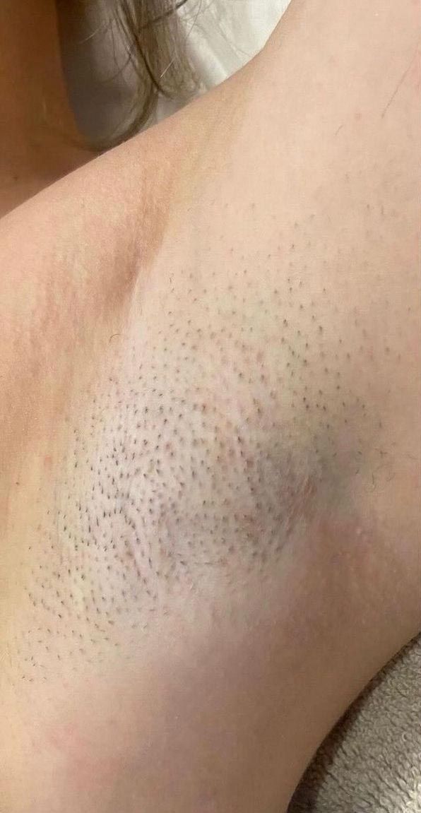 Un primo piano dell'ascella di una persona con molti peli.