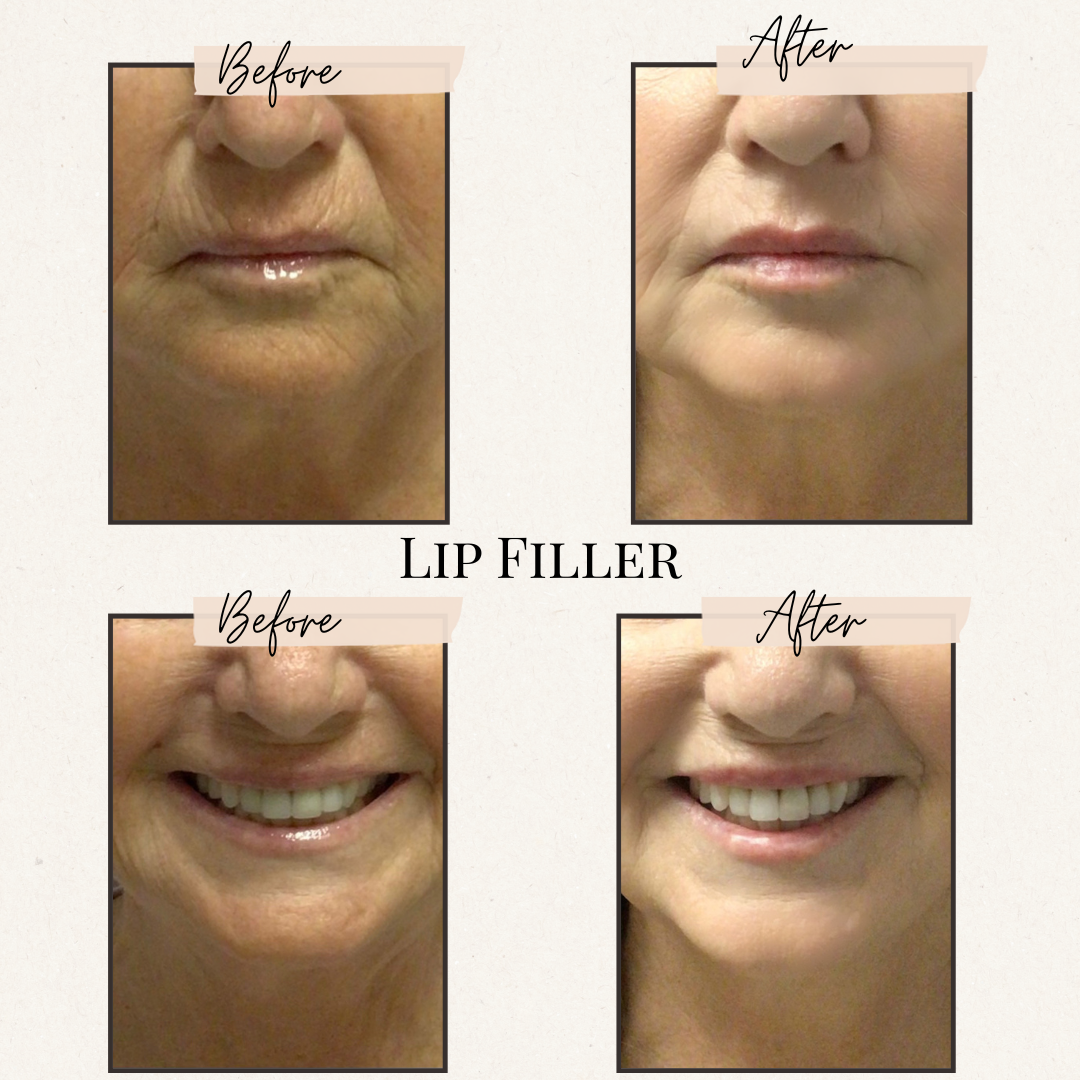 Lip filler before and after comparison: Upper lip wrinkles reduced, and smile lip fullness enhanced.