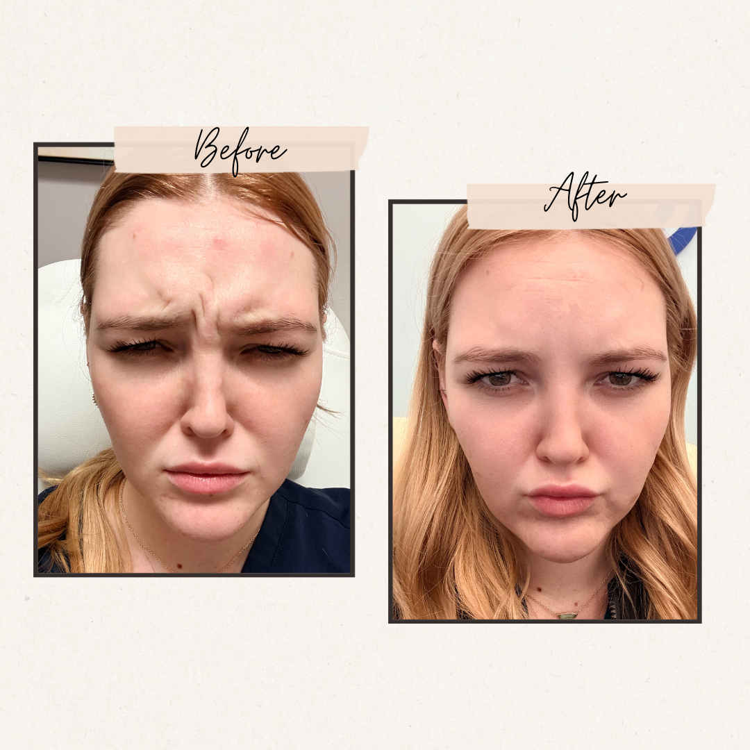 Side-by-side comparison. Woman's brow furrowed 