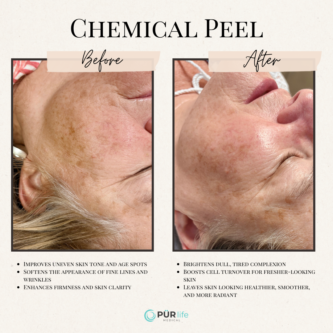 Before and after photos showing skin improvements from a chemical peel. Skin discoloration reduced.