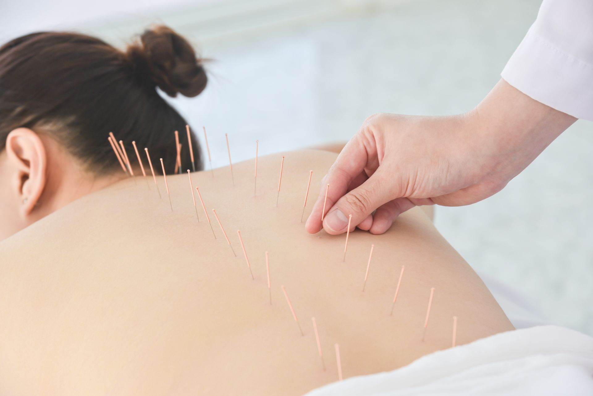 A woman is getting acupuncture on her back by a doctor.