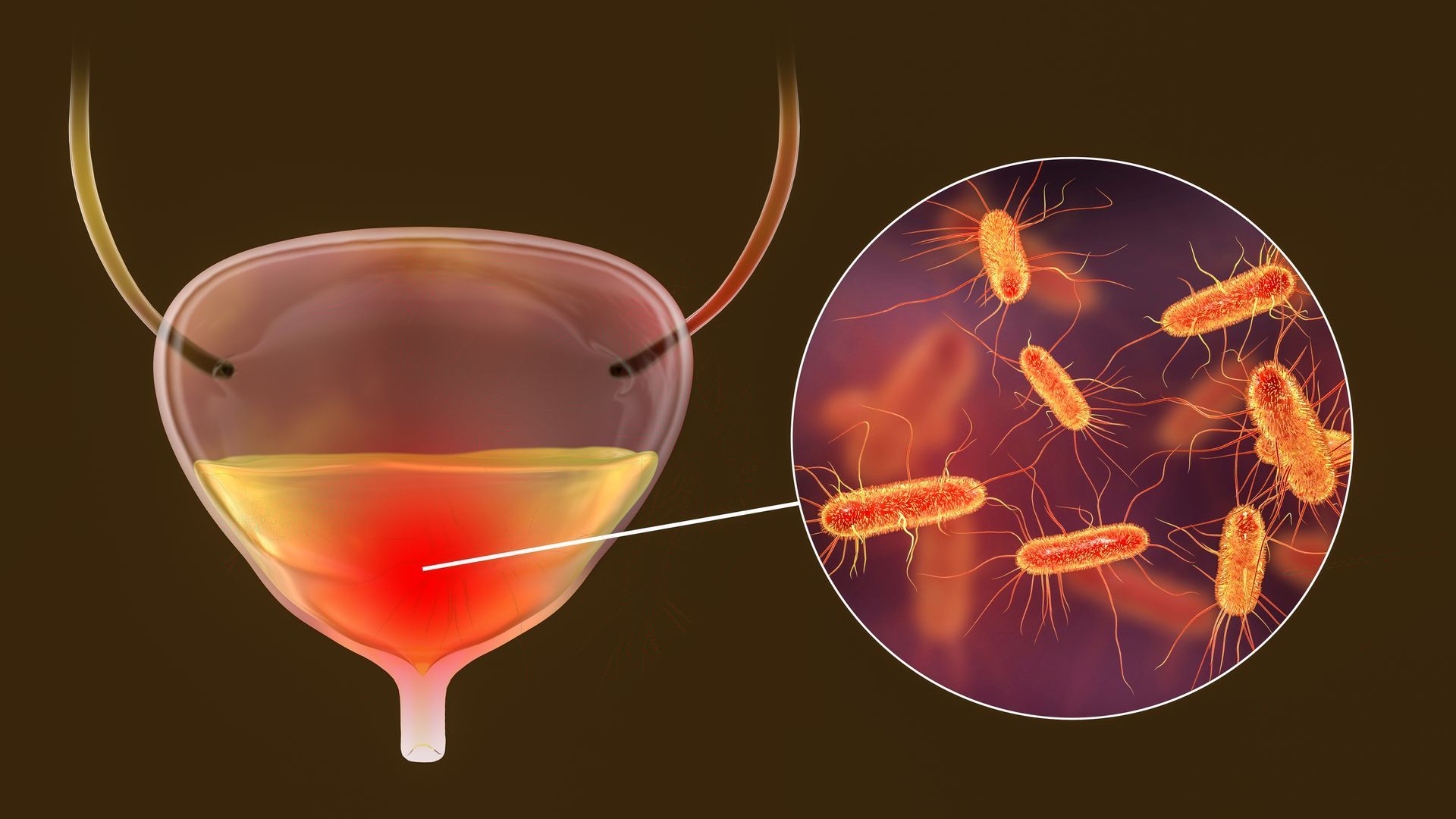 Medical illustration of cystitis showing bladder inflammation and bacteria in the urinary tract