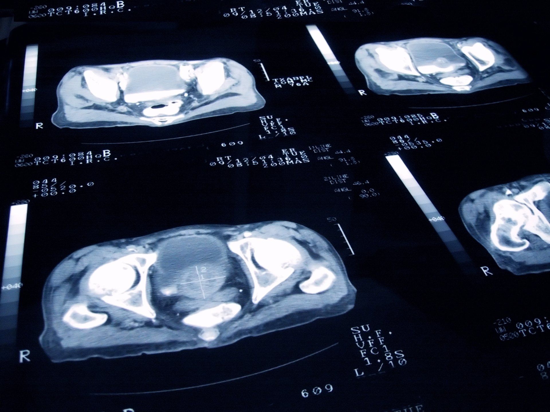 Prostate Screening — High Point, NC— Medical Center Urology PA