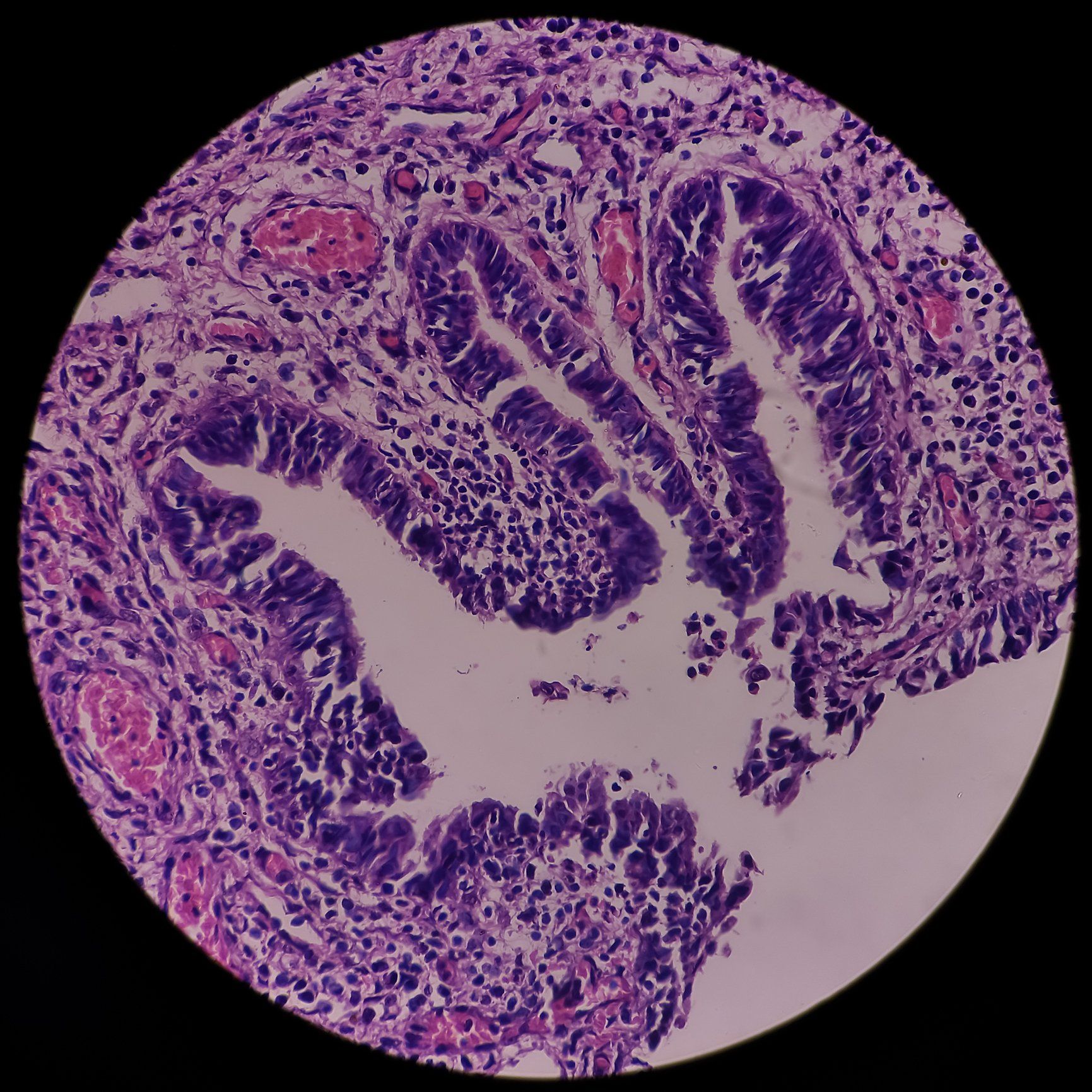Interstitial Cystitis — High Point, NC— Medical Center Urology PA