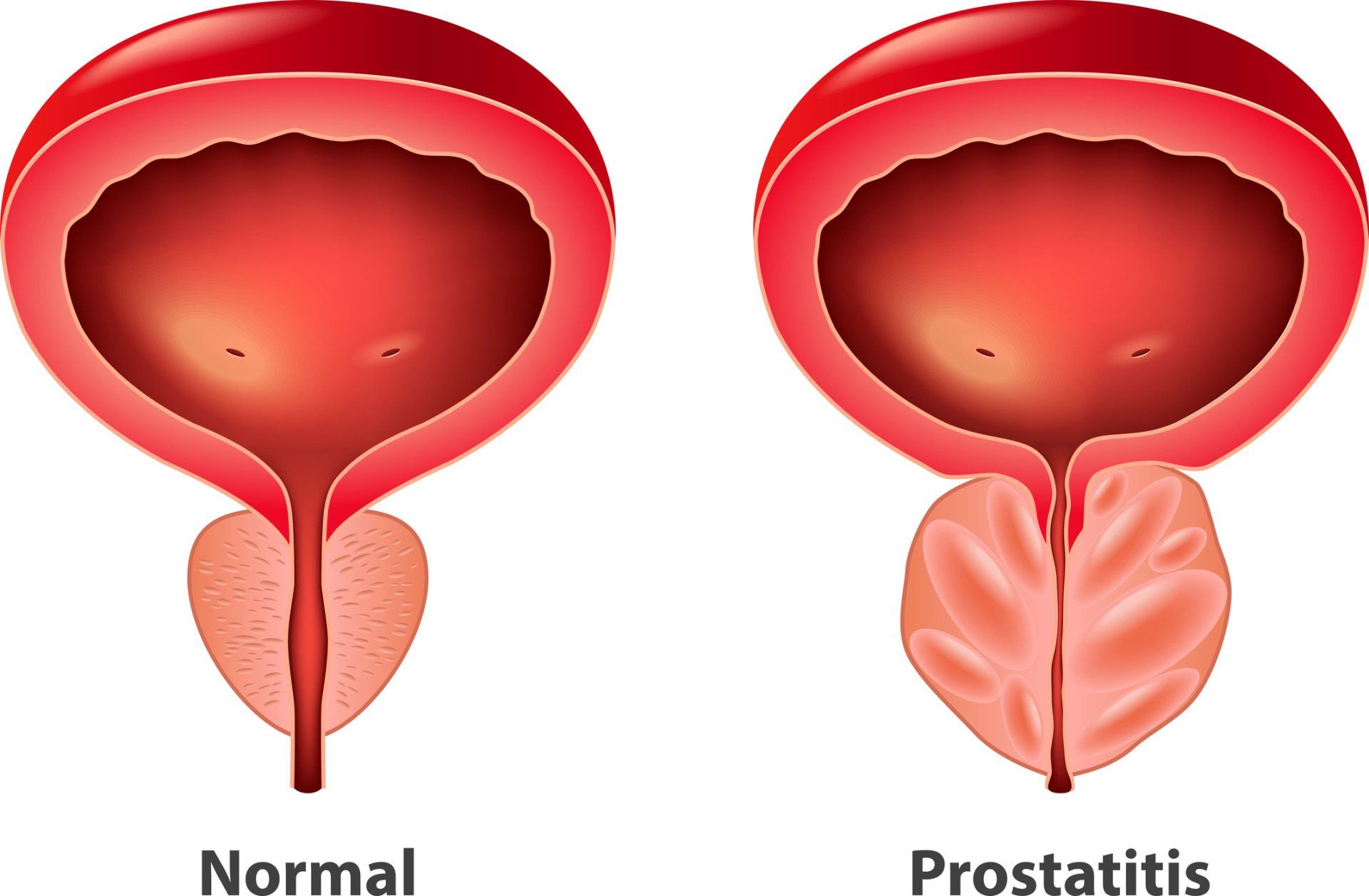 Compaison of Normal and Prostatitis — High Point, NC— Medical Center Urology PA