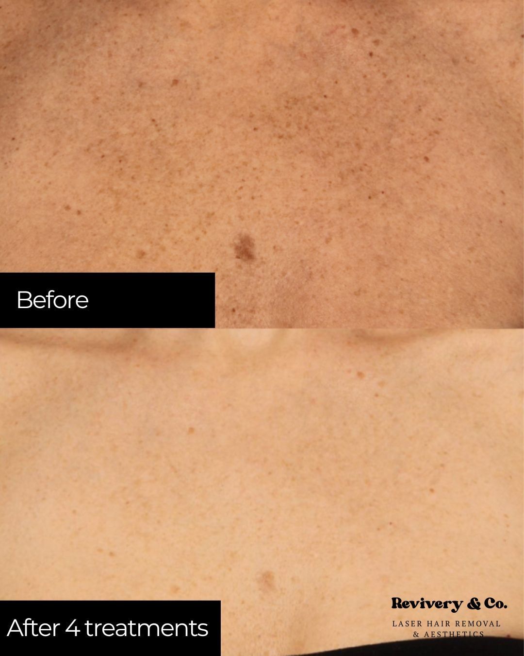 pigment removal cochrane laser treatment