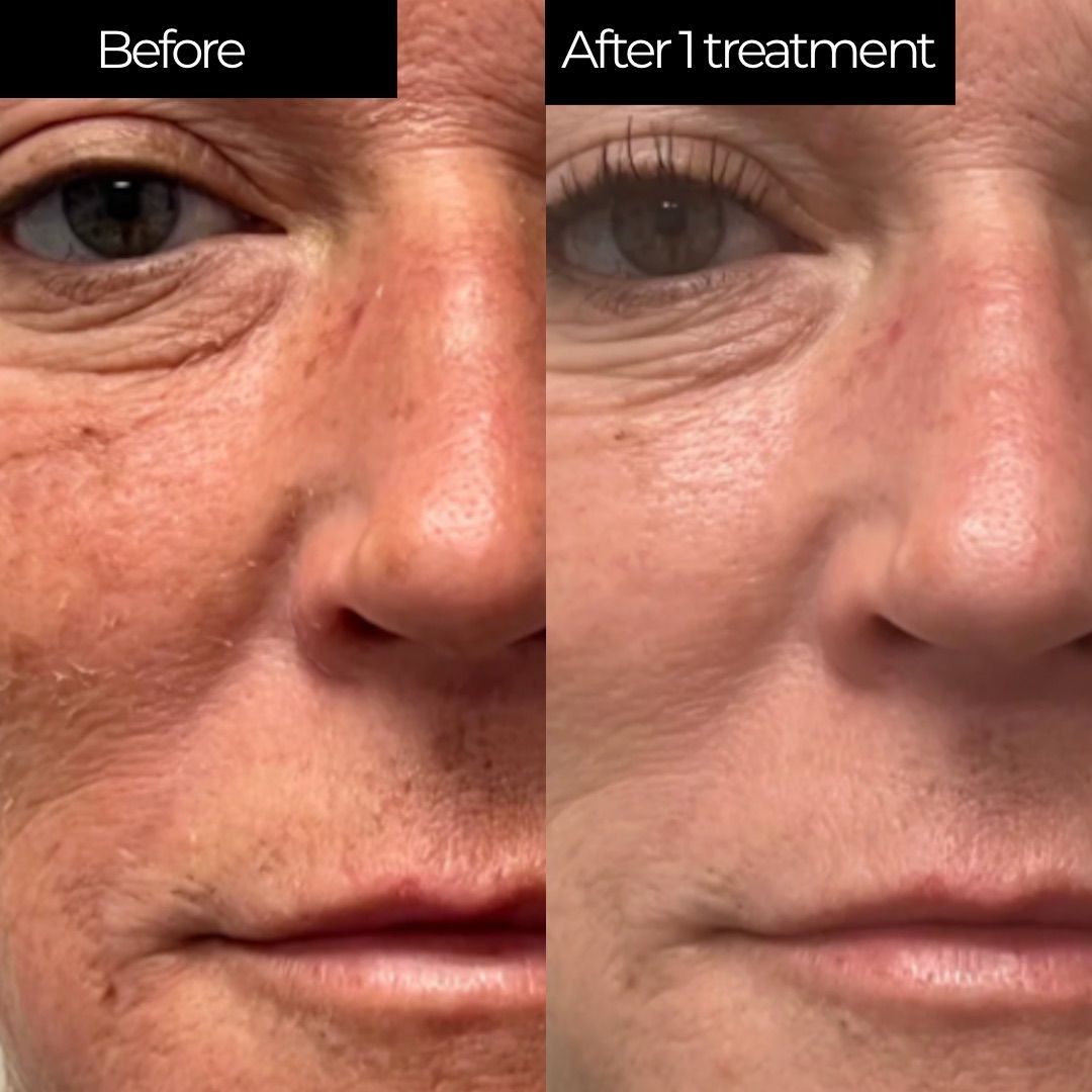 chemical peel cochrane