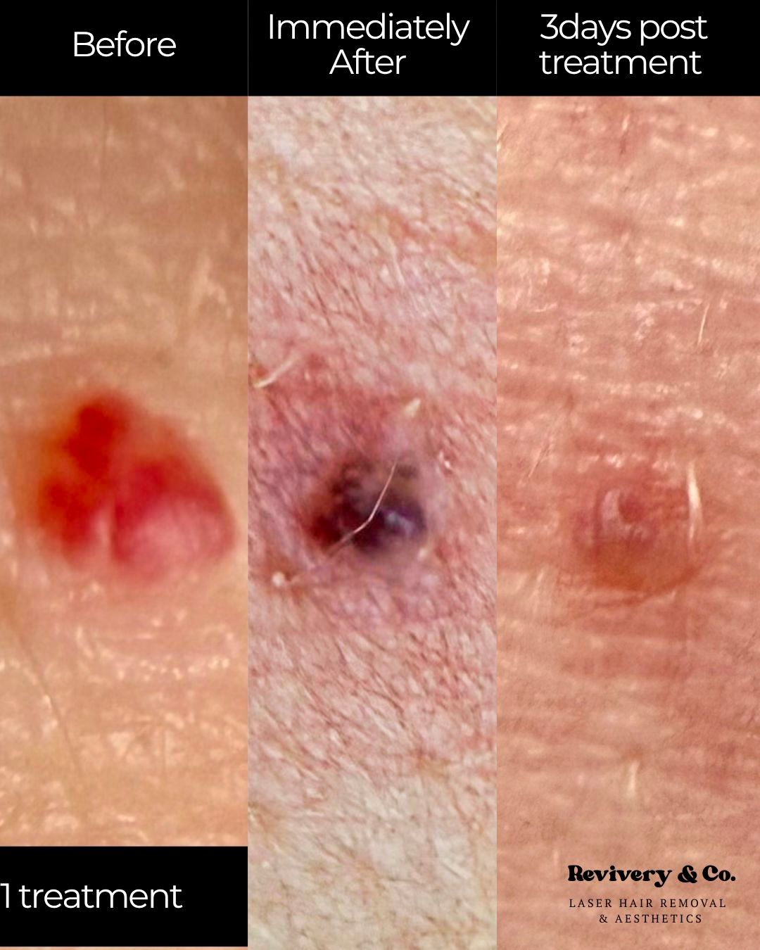 laser skin treatment cochrane
