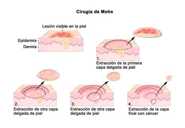 DRA. LETICIA BOETA ANGELES  - Cirugía Mosh