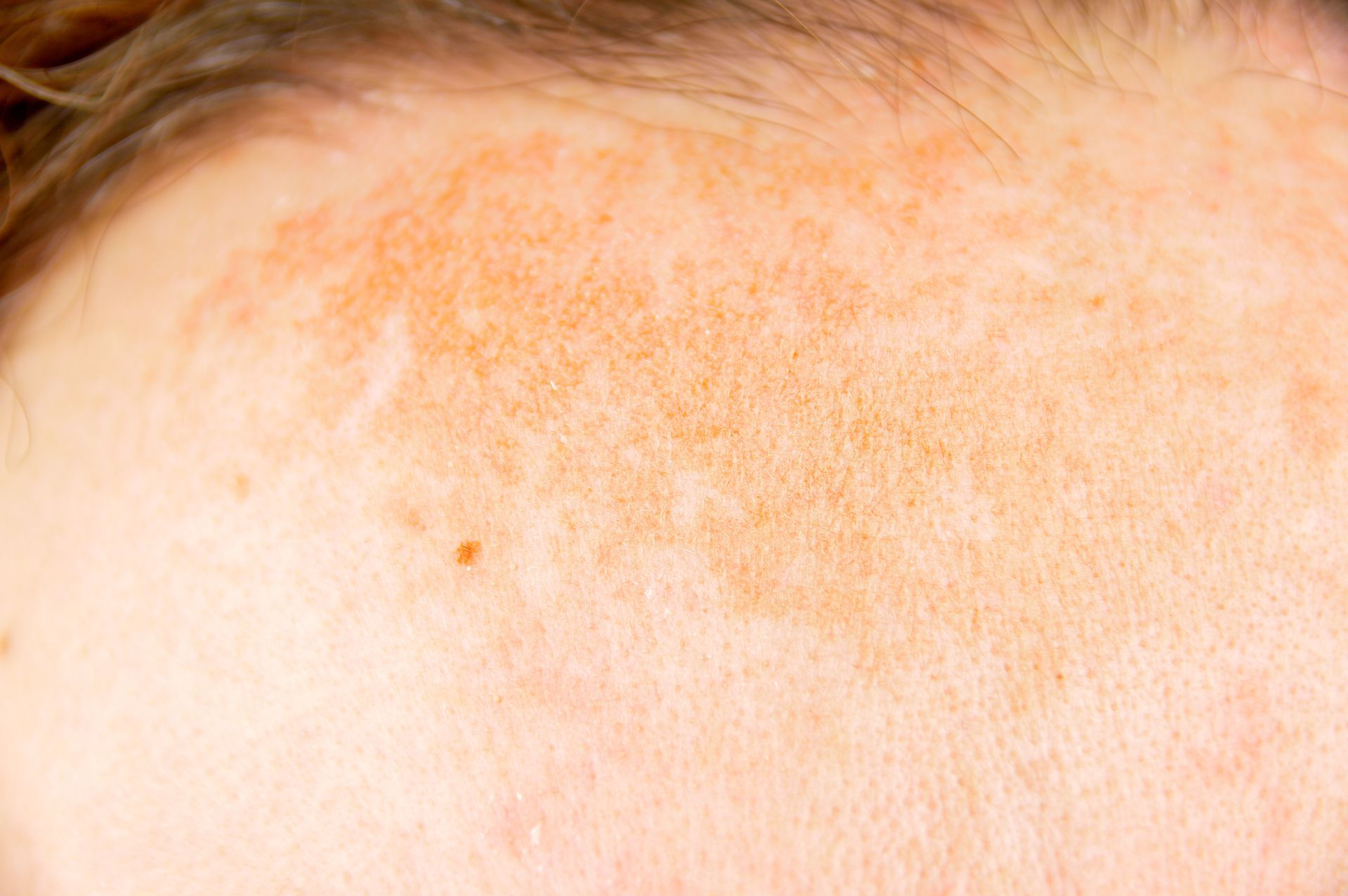 melasma treatment in San Francisco