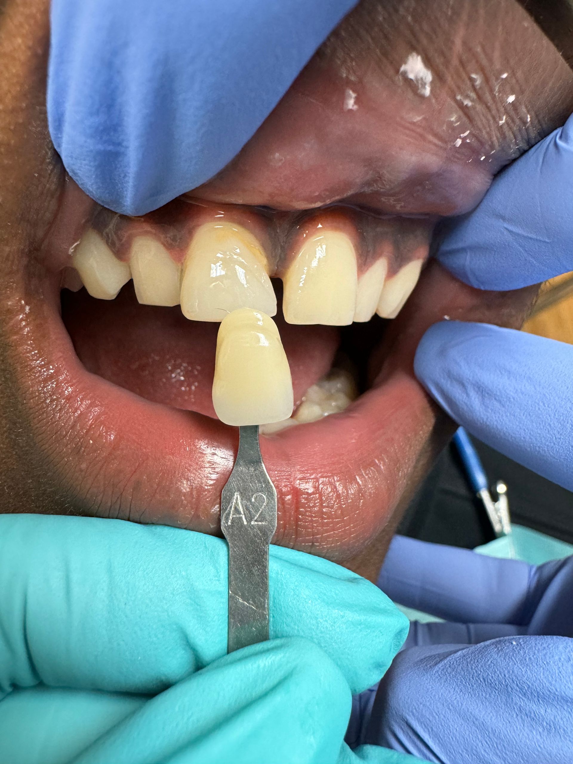 Dentist holding a tooth shade guide near a patient's teeth.