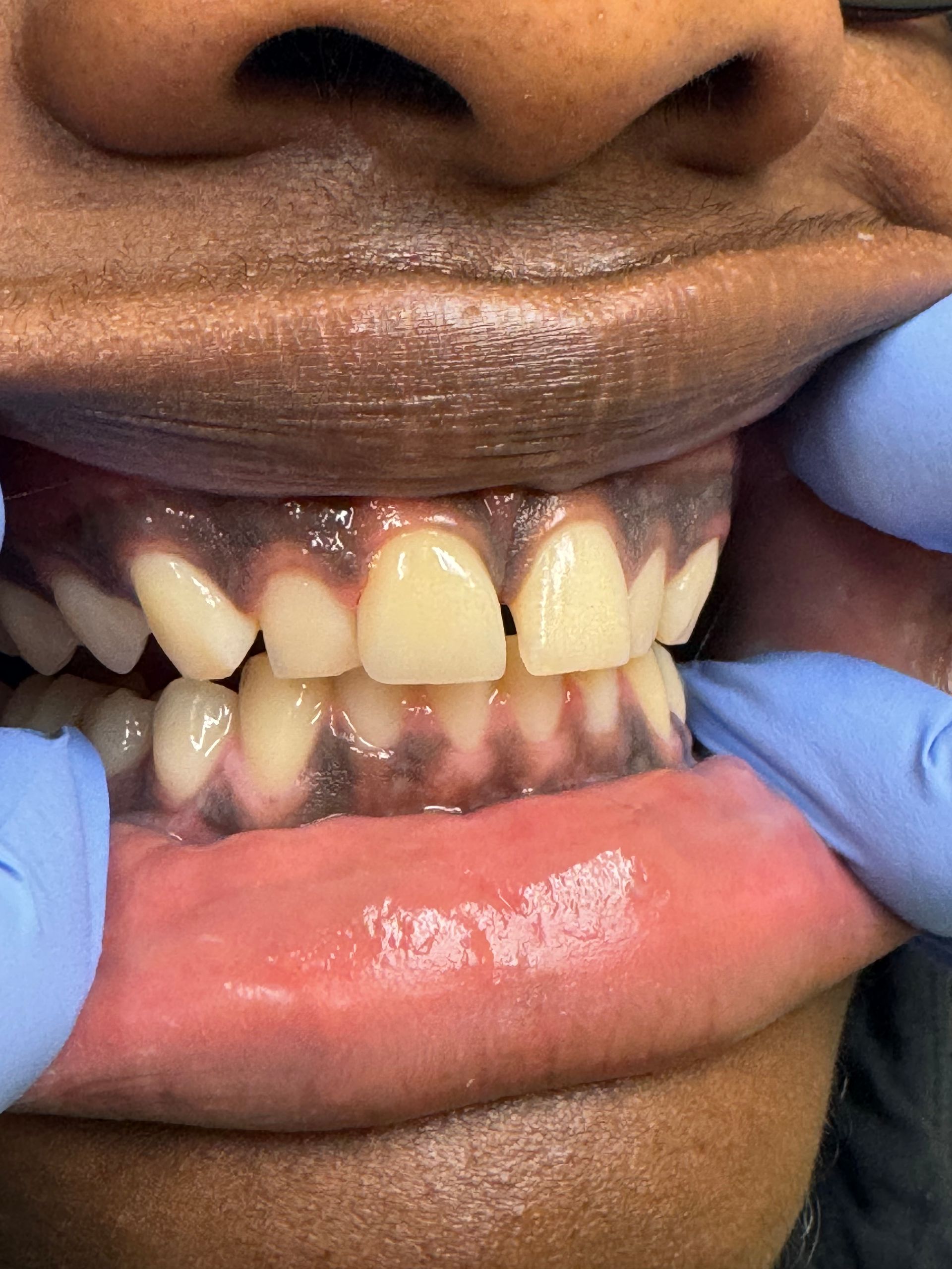 Close-up of teeth and gums with dark discoloration. Gloved hands hold lips open, showing lower teeth.