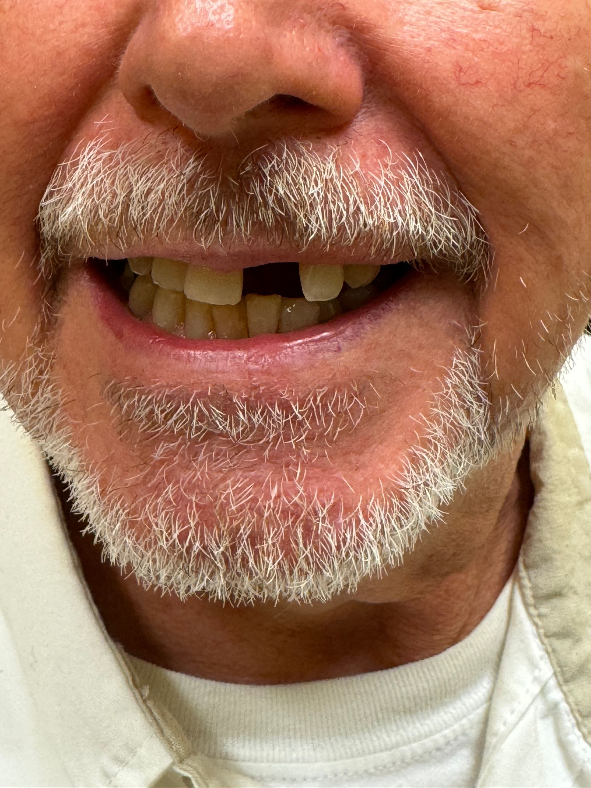 Smiling person with a partial tooth gap. Visible beard and upper teeth.