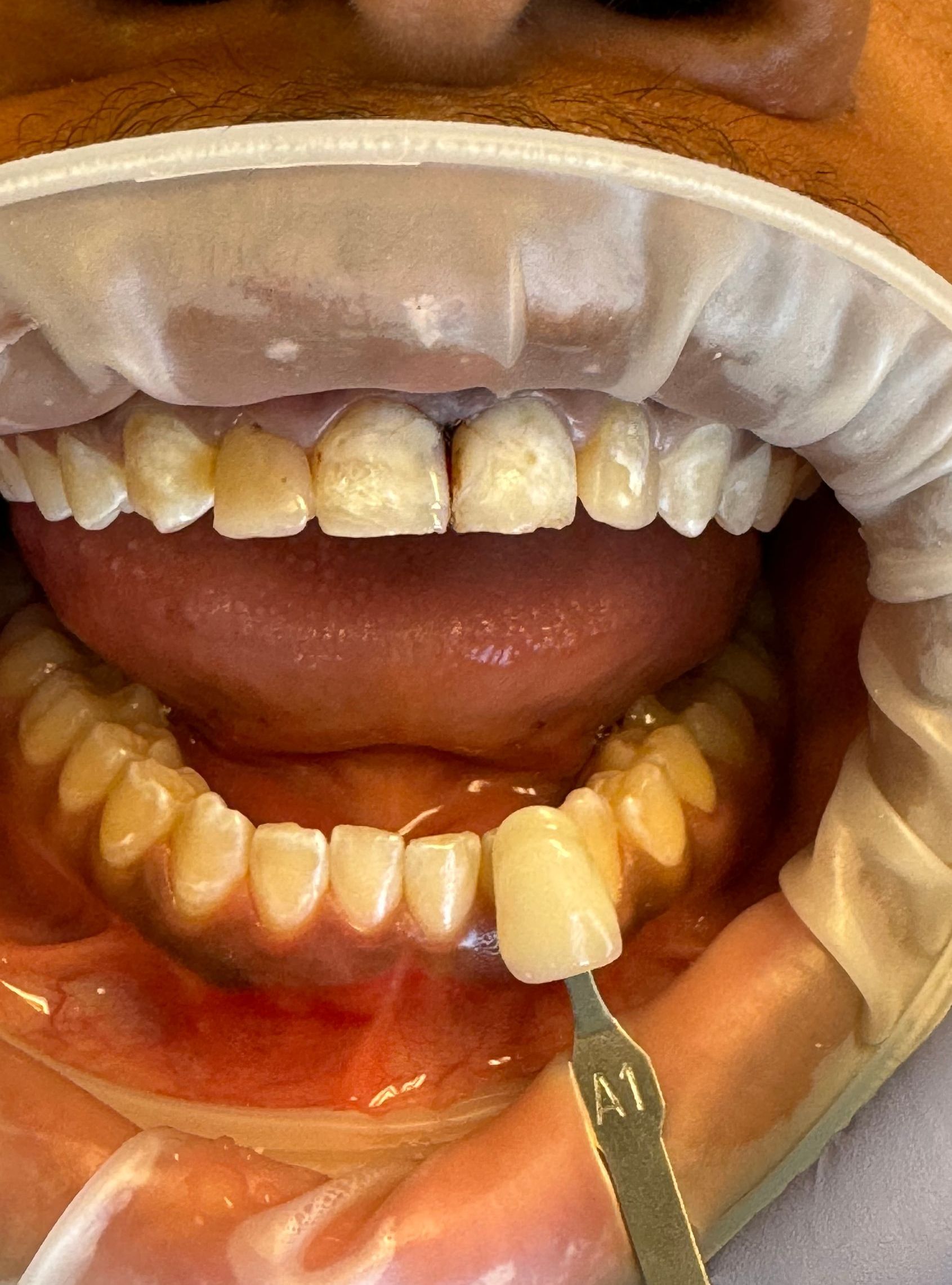 Mouth open, teeth with staining; dental shade guide shows A1 color, likely for comparison during whitening.