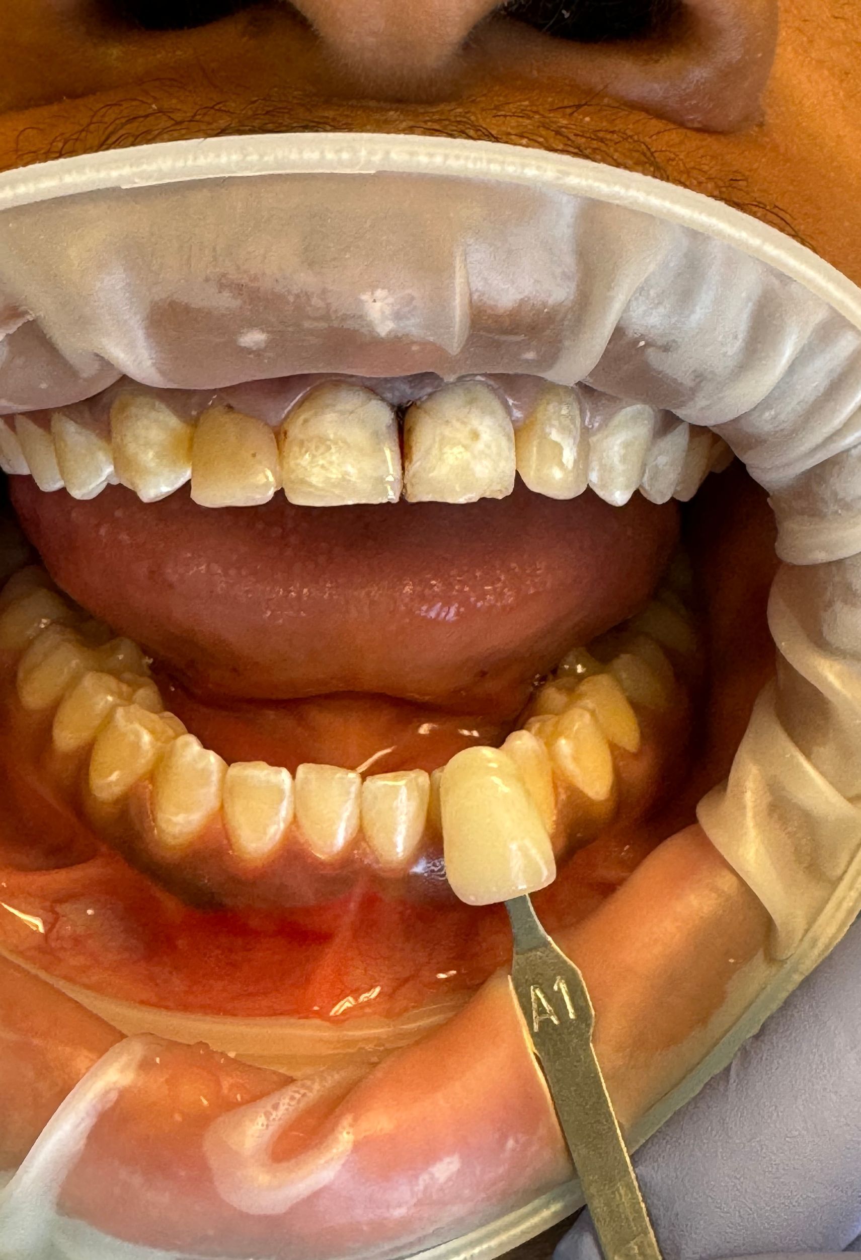 Dental examination: A dentist's shade guide next to a patient's teeth. Teeth are yellowed. A1 shade is selected.